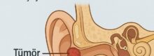 kulak tümörü nedir